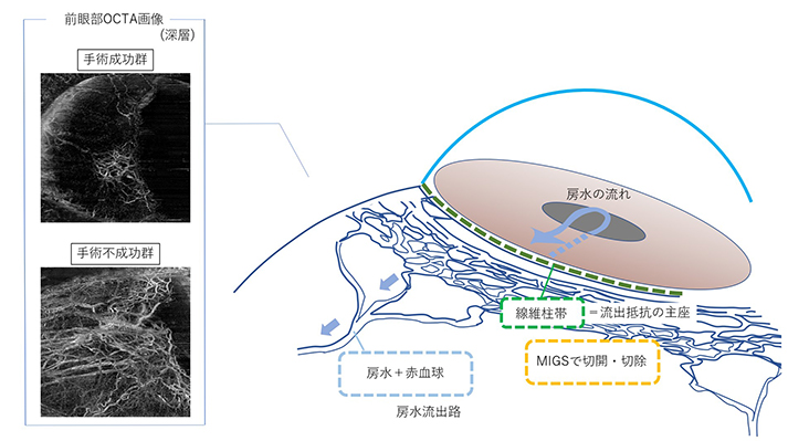 前眼部OCTAを用いた線維柱帯切開術効果予測 －房水主流出路の可視化