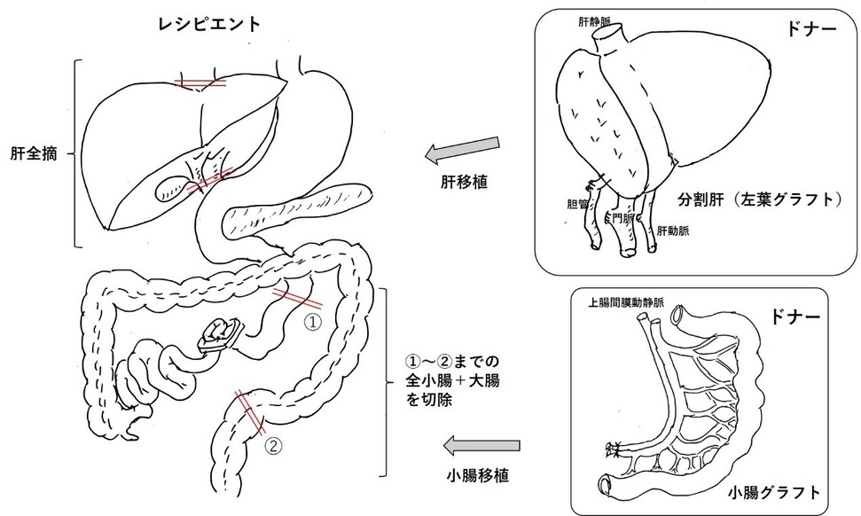 小腸切除術はどのように行われるのですか?